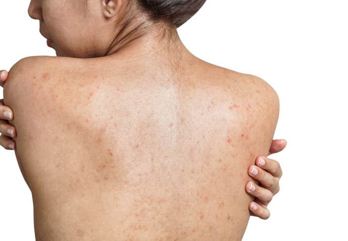 Dos d’une femme présentant des boutons d’acné – soin par Shiatsu pour l’acné au cabinet Terre de Shiatsu Lyon 5e, pour apaiser les inflammations et rééquilibrer l’énergie corporelle.