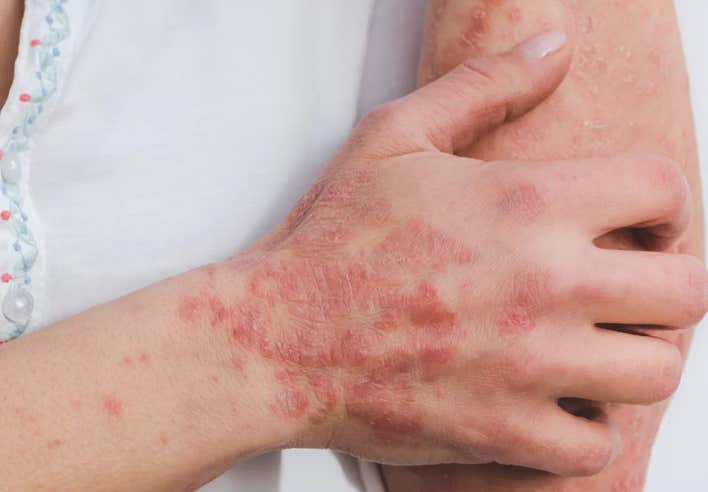 Avant-bras avec plaques de psoriasis rouges et squameuses – massage apaisant pour le psoriasis au cabinet Terre de Shiatsu Lyon 5e favorisant la régénération de la peau et le soulagement des tensions.