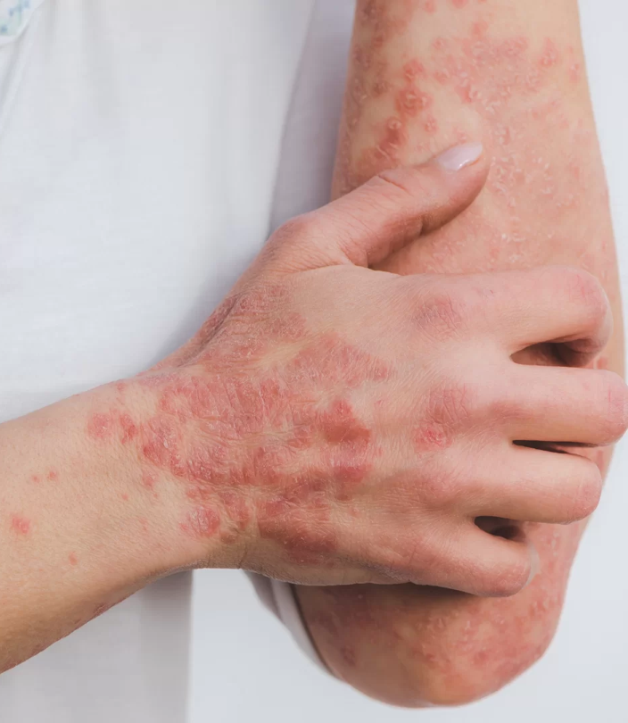 Main et avant-bras marqués par des lésions cutanées de type eczéma ou psoriasis, illustrant les troubles dermatologiques que le shiatsu peut apaiser en rééquilibrant l’énergie interne et émotionnelle - Cabinet Terre de Shiatsu Lyon 5e