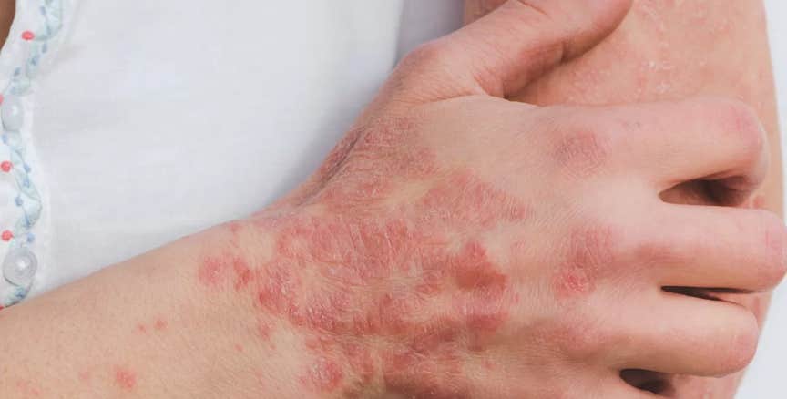 Main et avant-bras marqués par des lésions cutanées de type eczéma ou psoriasis, illustrant les troubles dermatologiques que le shiatsu peut apaiser en rééquilibrant l’énergie interne et émotionnelle - Cabinet Terre de Shiatsu Lyon 5e
